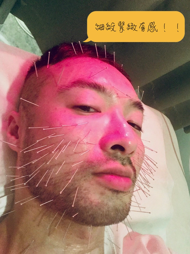 為什麼越來越多男生愛上美顏針？