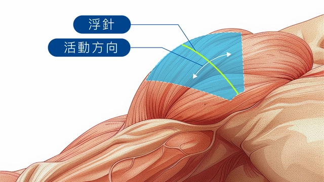 新浮針療法，讓生病肌肉快速恢復健康的張力